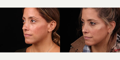 Rhinoplasty before and after photo