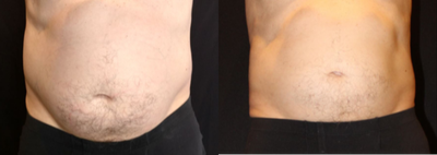 CoolSculpting before and after photo