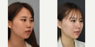 Double Eyelid Surgery before and after photo
