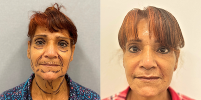Facelift before and after photo