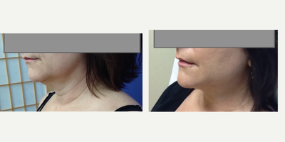 Laser Liposuction before and after photo