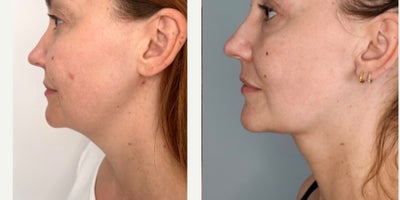 Neck Lift before and after photo
