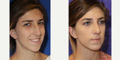 Rhinoplasty before and after photo