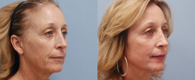 Chemical Peel before and after photo