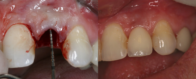 Dental Implants before and after photo