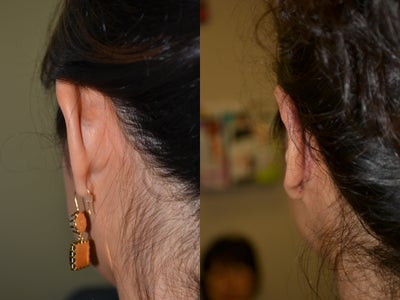 Ear Surgery before and after photo