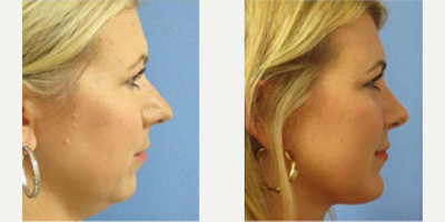 Facelift before and after photo