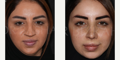 Sinus Surgery before and after photo