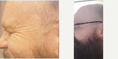 Botox before and after photo