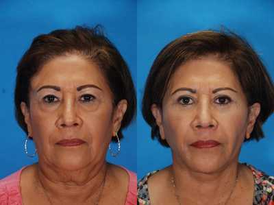 Facelift before and after photo