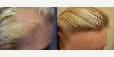 FUE Hair Transplant before and after photo