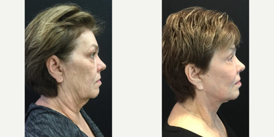 Facelift before and after photo