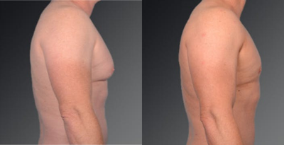 Gynecomastia Surgery before and after photo