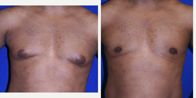 Gynecomastia Surgery before and after photo