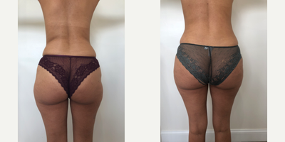 Liposuction before and after photo
