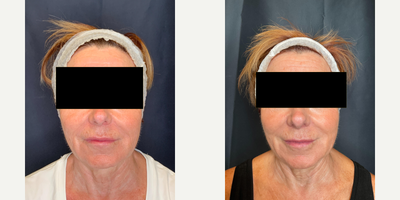 Microneedling RF before and after photo