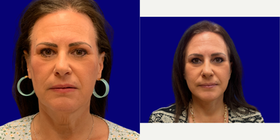 Neck Lift before and after photo