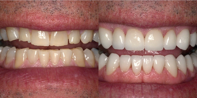 Porcelain Veneers before and after photo