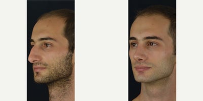 Rhinoplasty before and after photo
