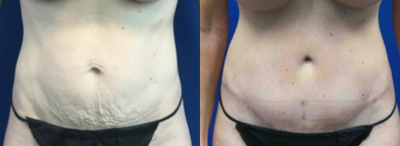 Tummy Tuck before and after photo