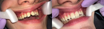 Dental Bonding before and after photo