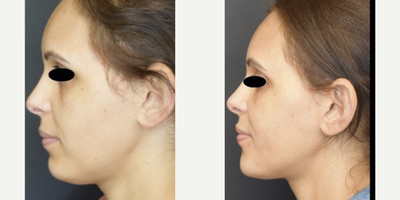 Dermal Fillers before and after photo