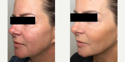 Halo Laser before and after photo