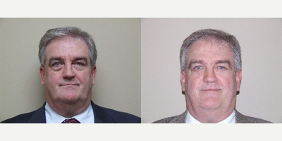Eyelid Surgery before and after photo