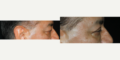 Eyelid Surgery before and after photo
