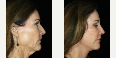 Facial Fat Transfer before and after photo
