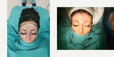 Forehead Reduction before and after photo
