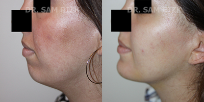 Chin Implant before and after photo