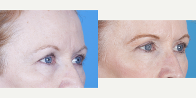 Eyelid Surgery before and after photo