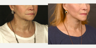 Neck Lift before and after photo