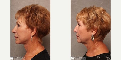 Neck Lift before and after photo