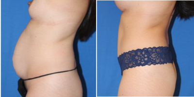 Tummy Tuck Revision before and after photo
