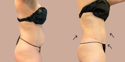 AirSculpt before and after photo