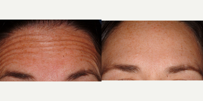Botox before and after photo