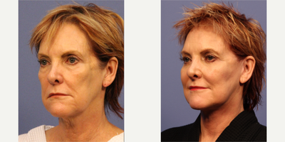 Facelift before and after photo