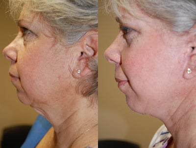 Facelift before and after photo
