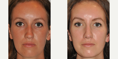 Rhinoplasty before and after photo