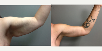 Arm Lift before and after photo