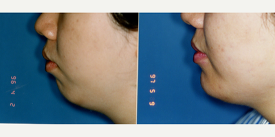 Chin Implant before and after photo