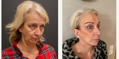 Eyelid Surgery before and after photo