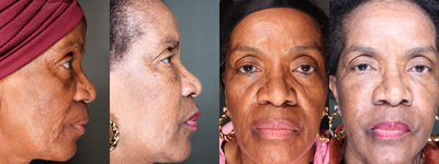 Facial Fat Transfer before and after photo