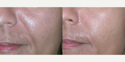 Juvederm before and after photo