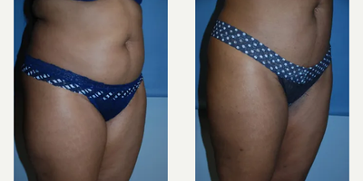 Liposuction before and after photo