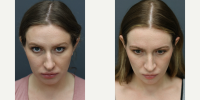 Rhinoplasty before and after photo