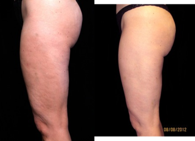 Cellulaze before and after photo
