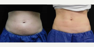 CoolSculpting before and after photo